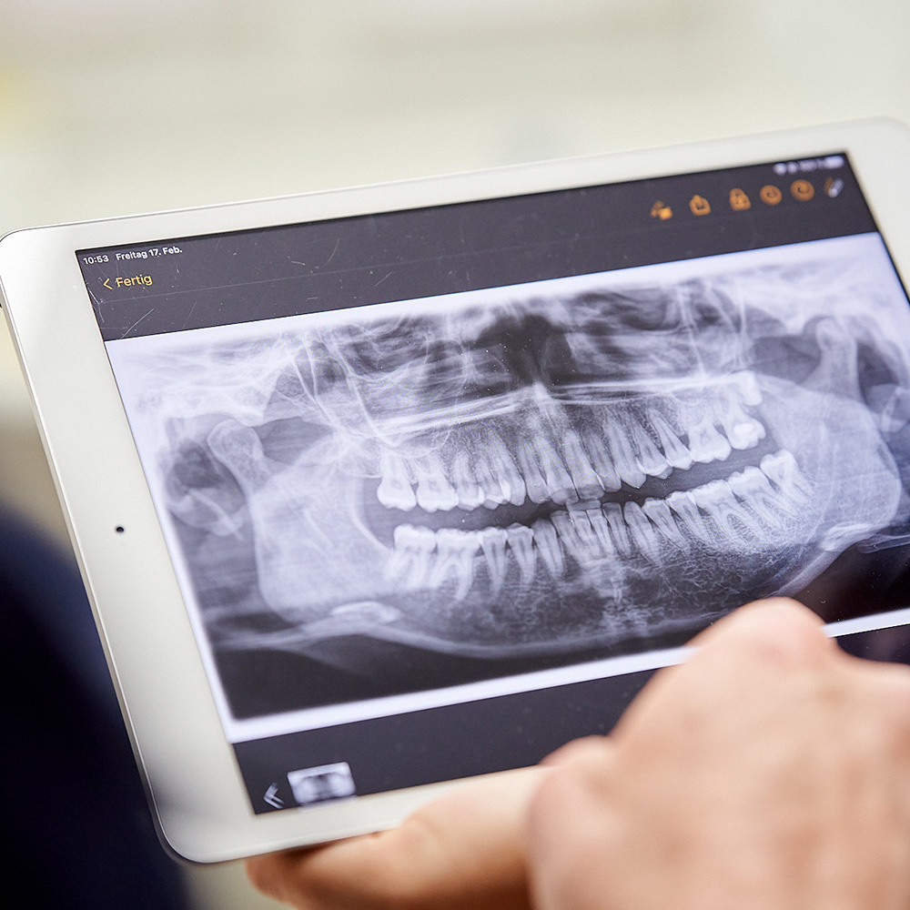 Symbolbild Knochenaufbau: Wir sehen einen Ausschnitt eines Tablets, darauf ist das Röntgenbild eines Gebisses zu sehen